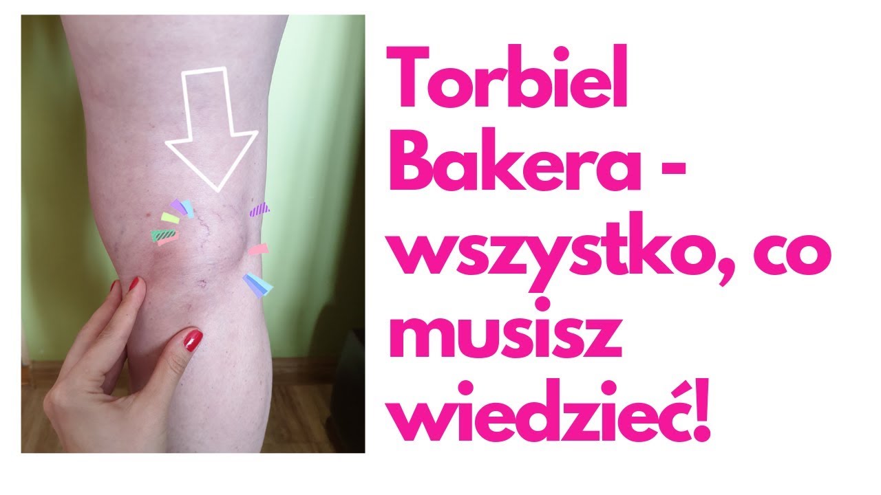 Wszystko, co musisz wiedzieć -Torbiel Bakera, cysta dołu podkolanowego