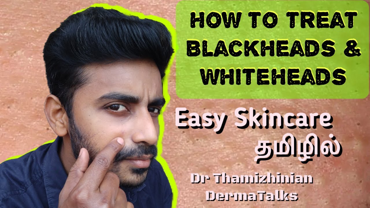 Blackheads and Whiteheads (Tamil) - How to treat?Causes, Prevention and treatment Dr Thamizhinian