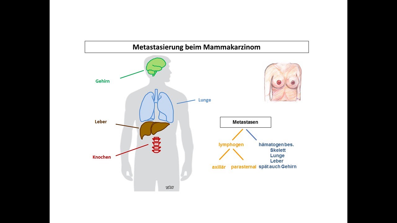 Metastasierung beim Mammakarzinom | Strahlentherapie Prof. Hilke Vorwerk