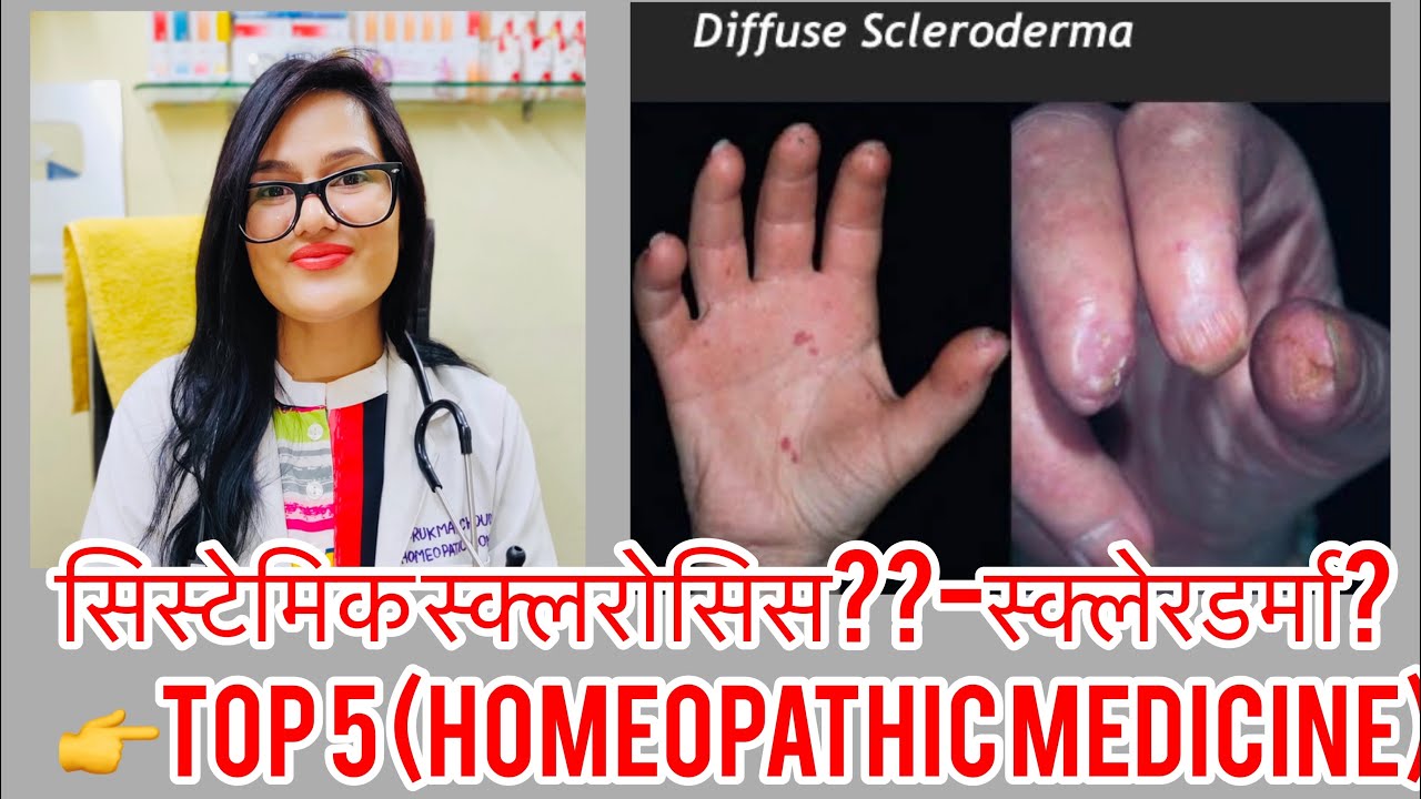 स्क्लरोसिस बेस्टइलाज?सकलेरोड़ेर्मा?homeopathy for scleroderma?Systemic sclerosis -Dr.rukmani Clinic