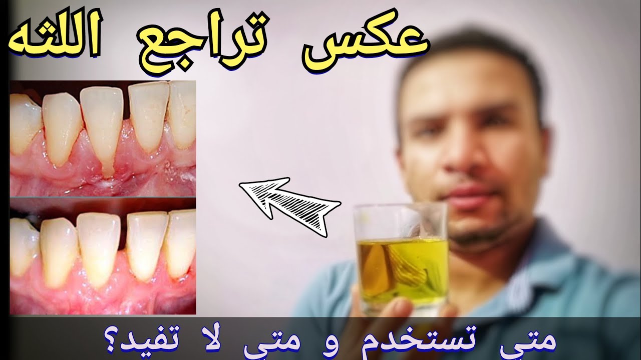 طرق اعاده بناء اللثه المتراجعه بسرعه| وصفات منزليه لعكس تراجع اللثه