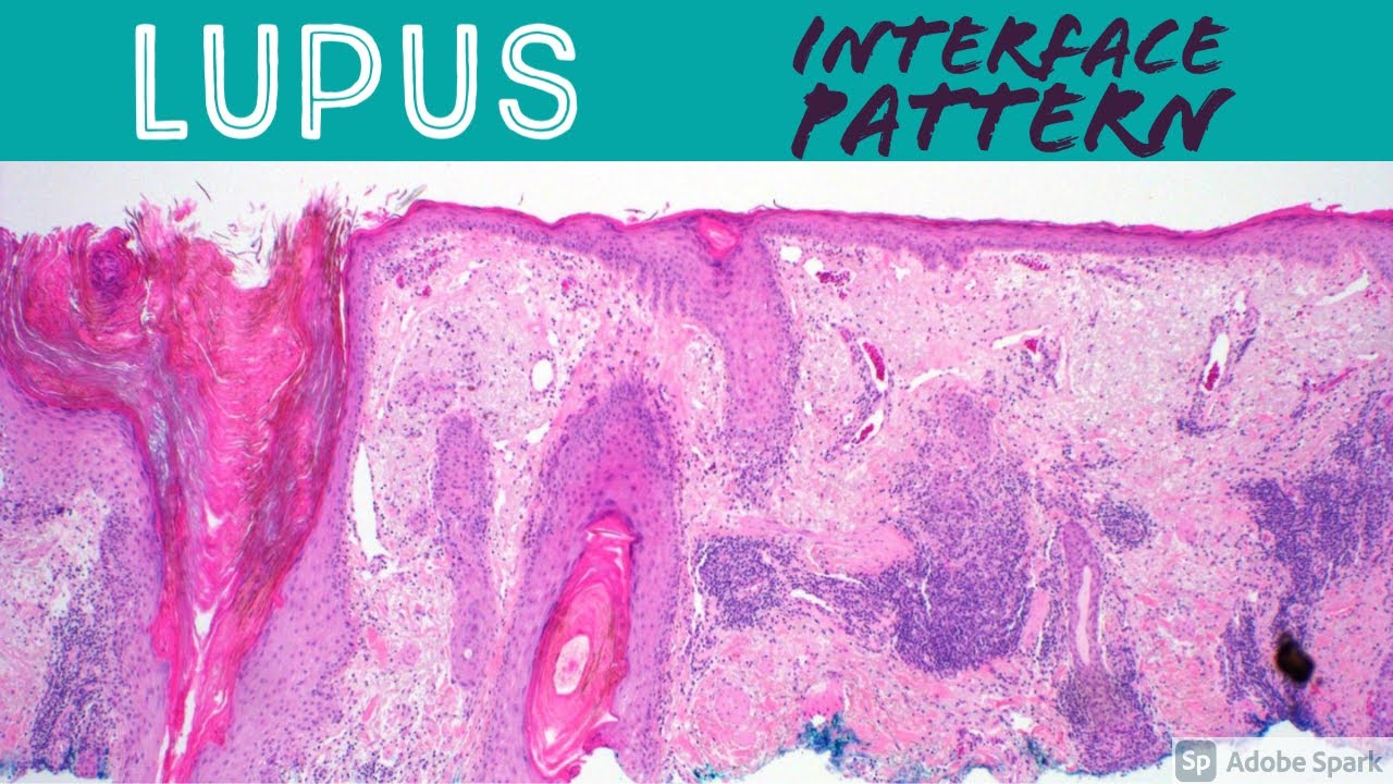 Lupus Erythematosus - Interface Dermatitis: Inflammatory Dermpath Basics for Dermatology & Pathology