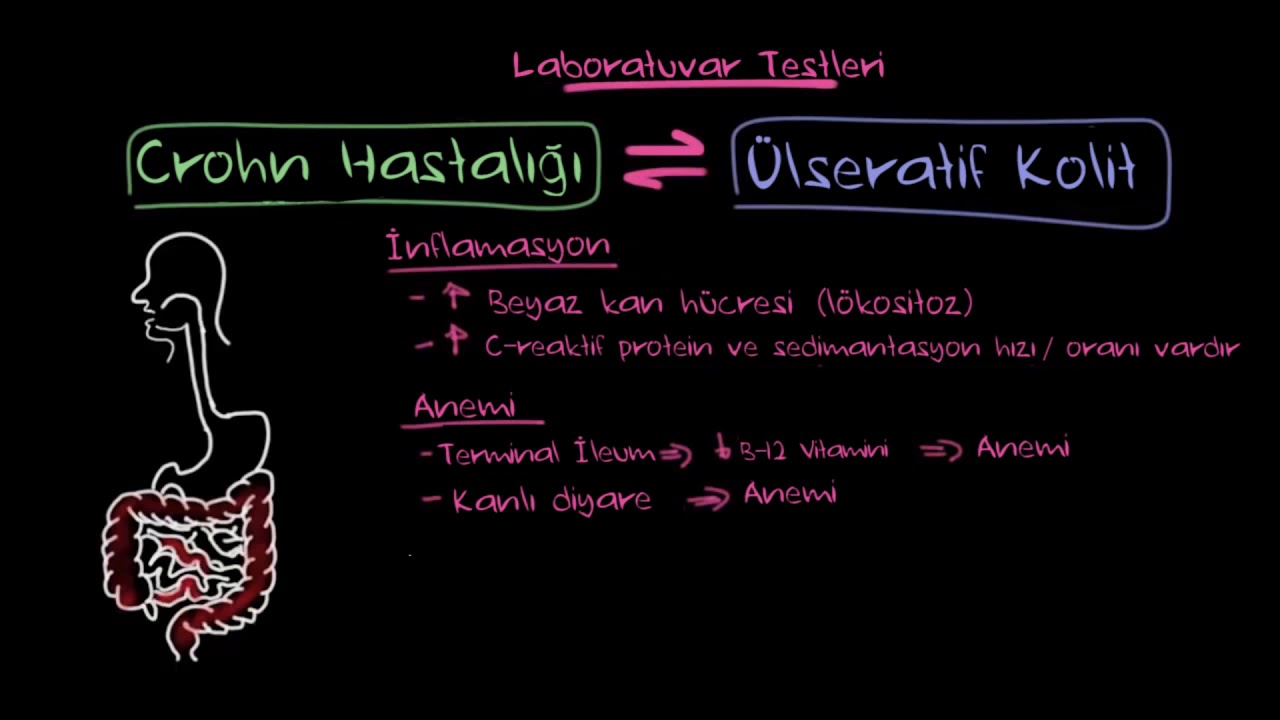 İnflamatuar Bağırsak Hastalığı Teşhisi (Fen Bilimleri) (Sağlık ve Tıp)