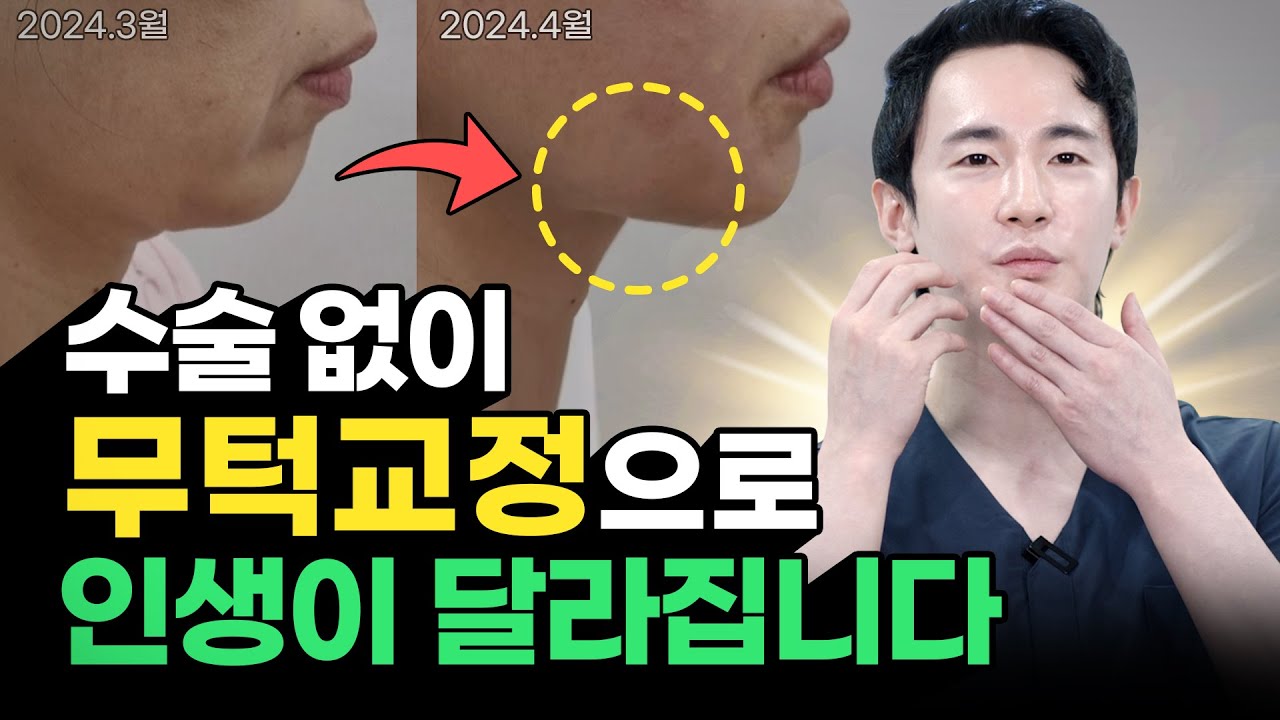 👍무턱필러 턱 끝 필러 말고 이거 하세요!👍수술 없이 간단하게 무턱교정하는 법