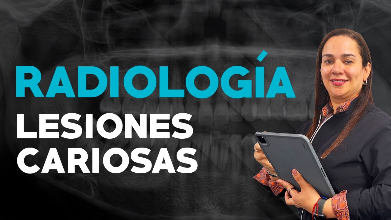 Lesiones Cariosas: Curso de Cariología Dental | FP Higiene Bucodental