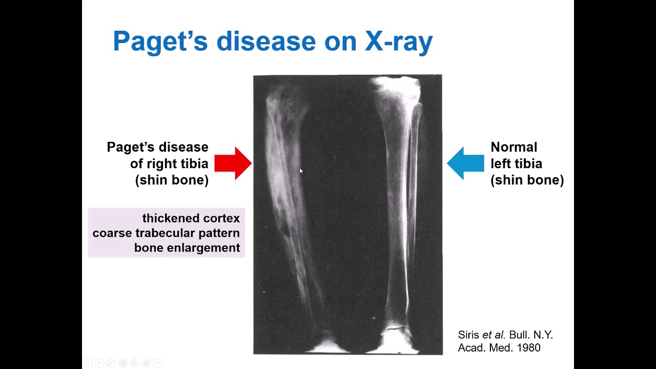 What is Paget’s Disease of Bone and how does bisphosphonate treatment work? Dr Daroszewska explains.