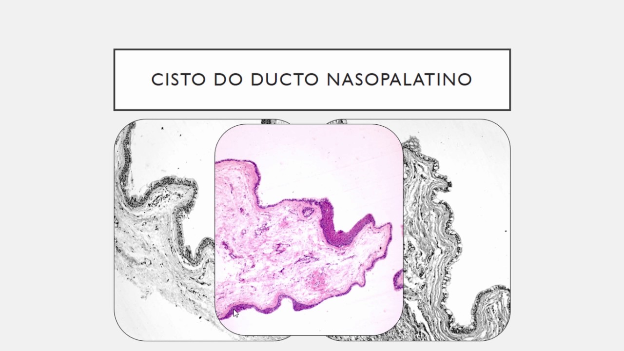 11 - CISTOS NÃO ODONTOGÊNICOS