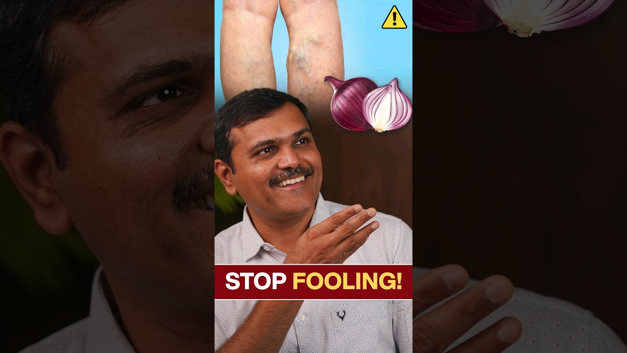 Onion Magic for VARICOSE Veins? The Shocking TRUTH!