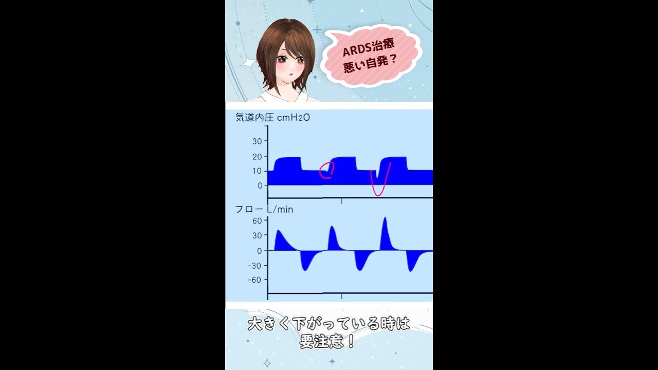 #Shorts-ARDSに悪い自発呼吸の話（P-SILI、P0.1）