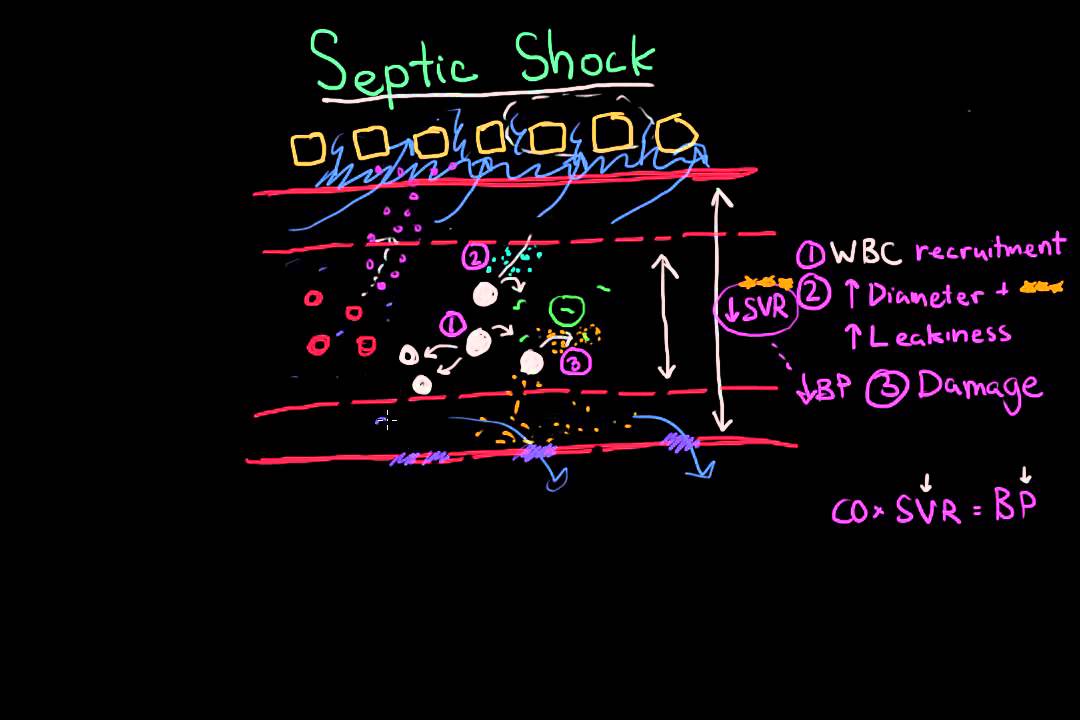 Septic Shock: Pathophysiology and Symptoms
