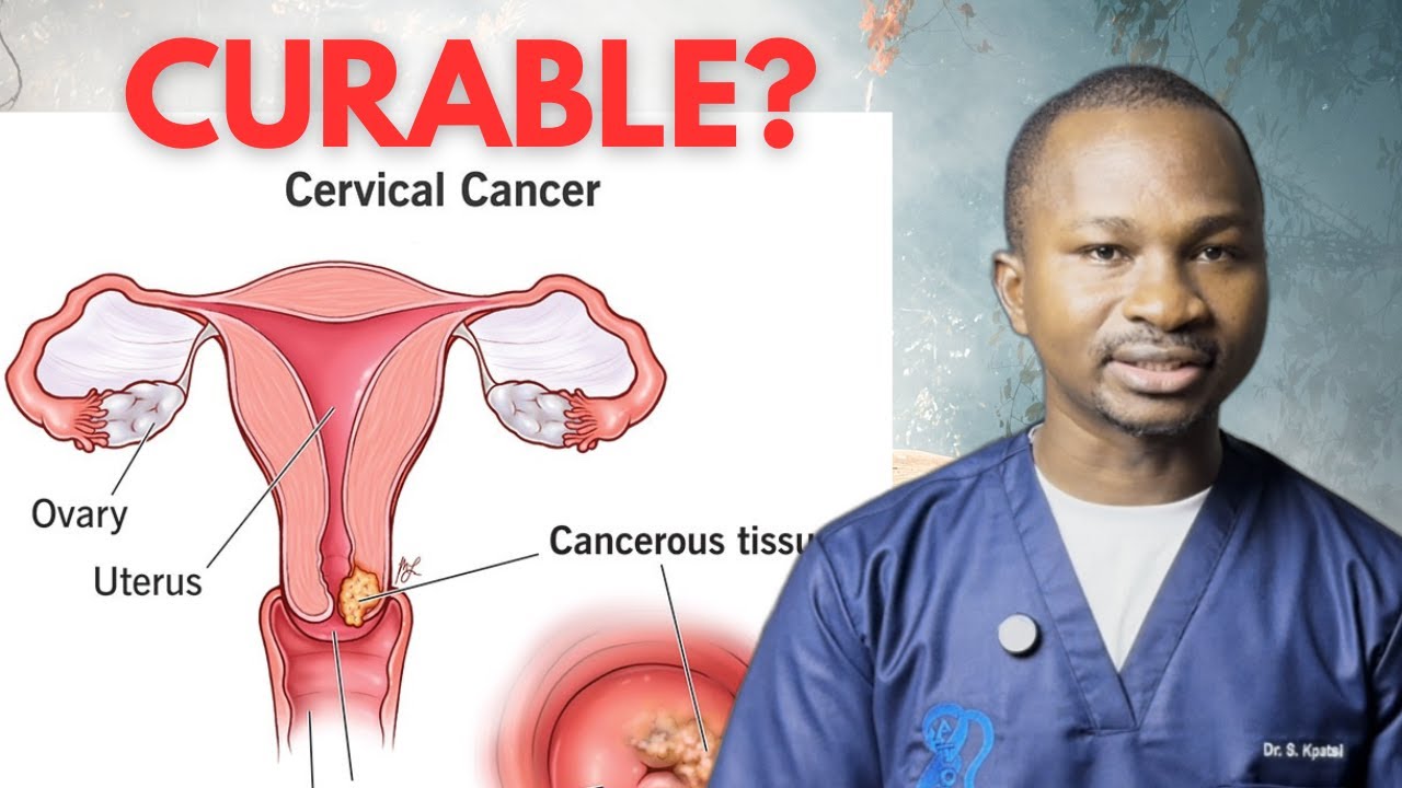 Can Cervical Cancer Be Cured? Factors That Affect Survival