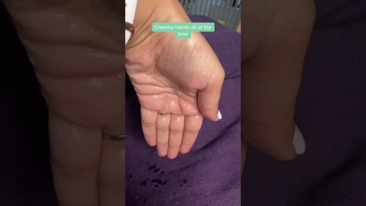 Clammy hands- overactive sweat glands (hyperhidrosis)