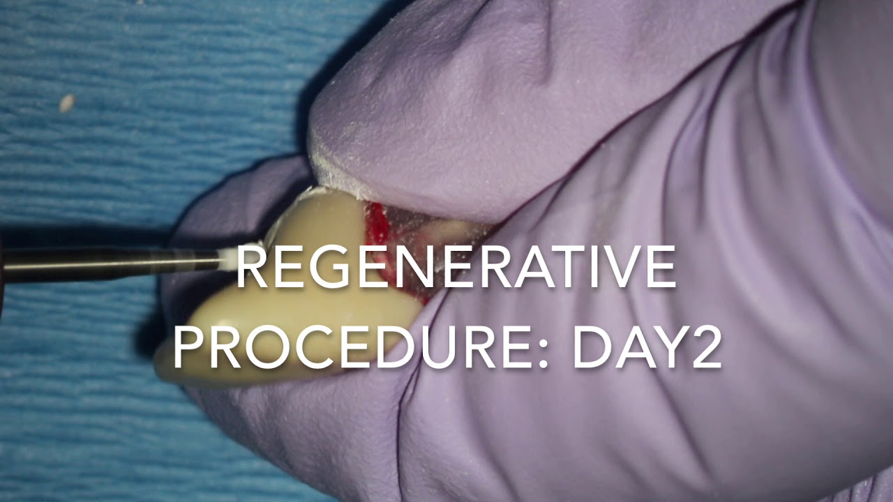 Regenerative Endodontics