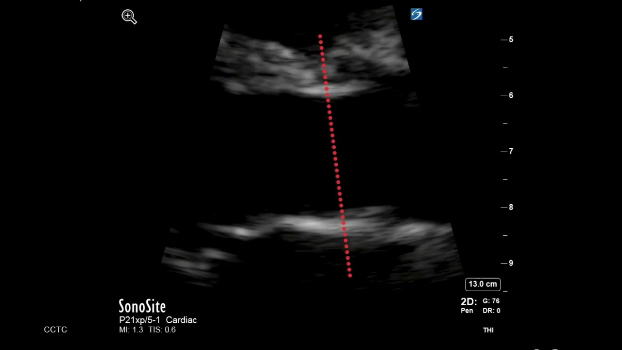 How to... Measure LVOT Diameter