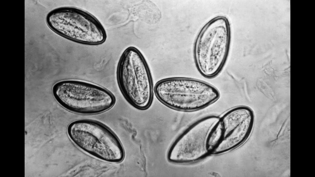 Enterobiasis (Pinworm infection)