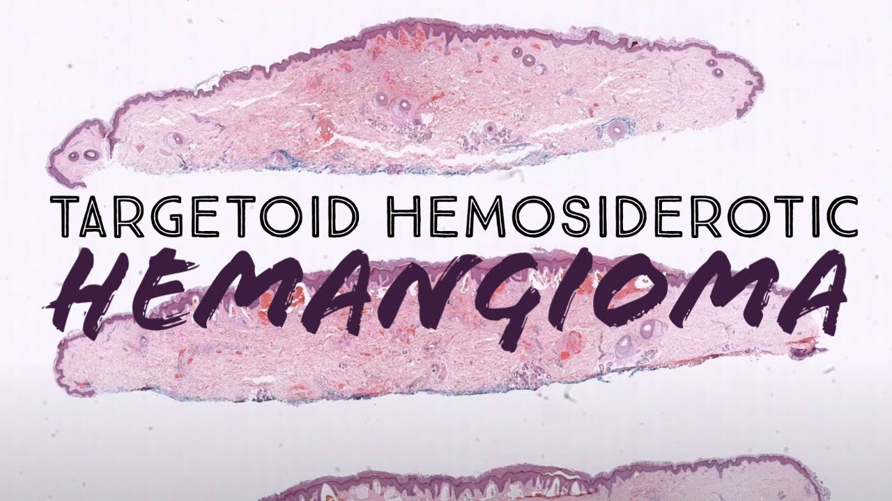 Targetoid hemosiderotic hemangioma (hobnail hemangioma) pathology dermatology dermatopathology