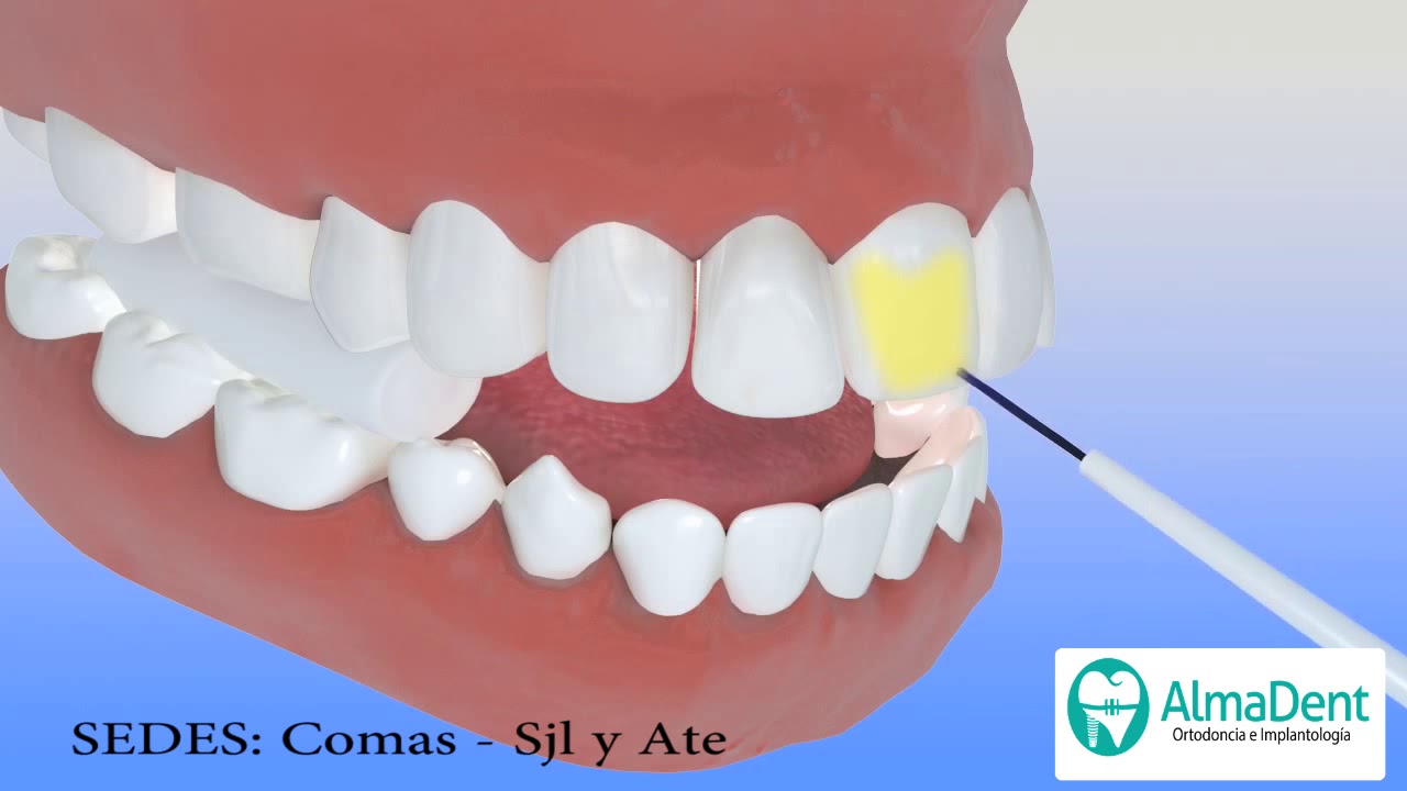 Almadent Per&uacute; y Colocaci&oacute;n de Brackets