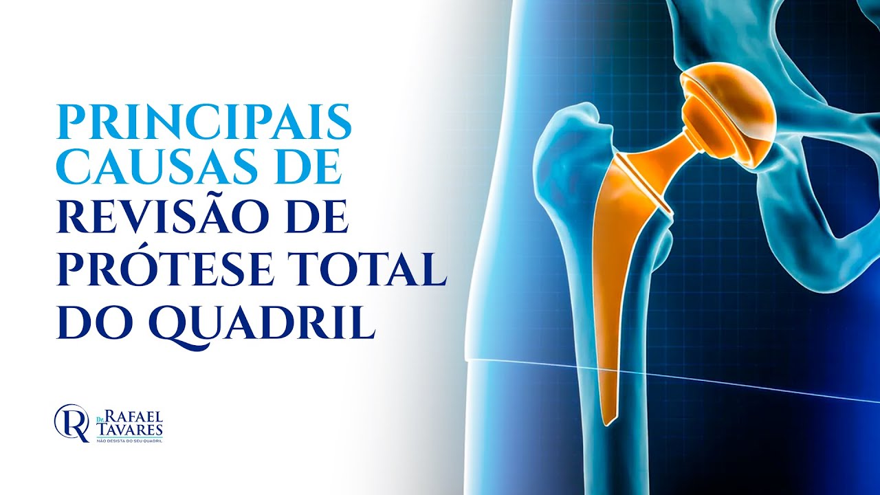Principais causas de revisão de prótese | Dr Rafael Tavares - Quadril