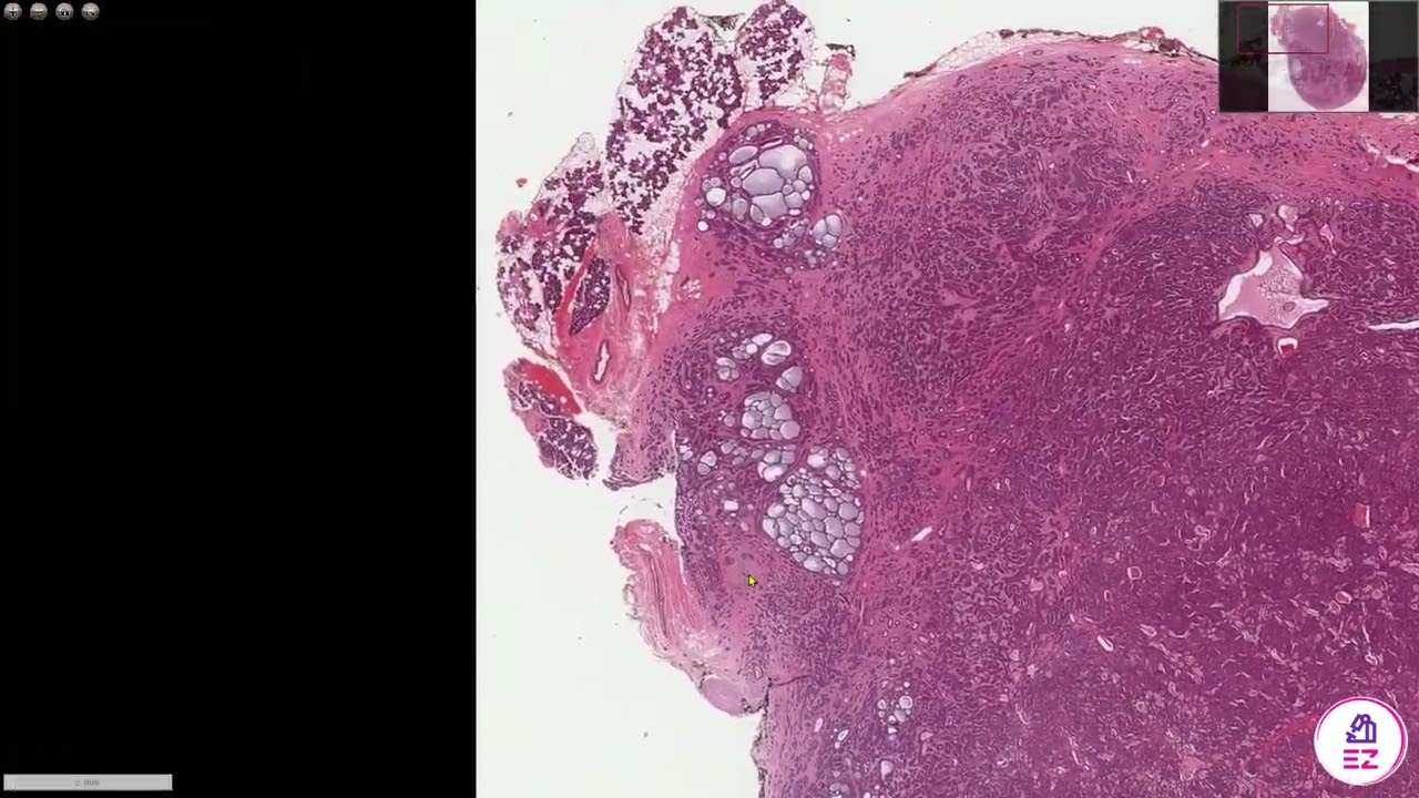 Adenoid Cystic Carcinoma