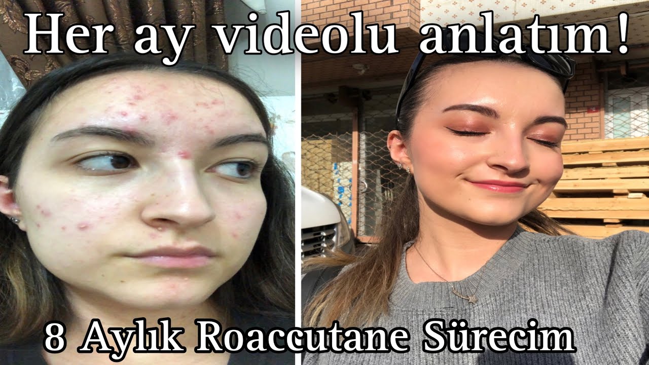 SİVİLCE TEDAVİM | Her Ay Videosunu Çektiğim 8 Aylık Roaccutane Sürecim