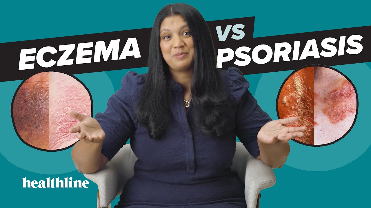 Is Your Skin Issue PSORIASIS or ECZEMA?