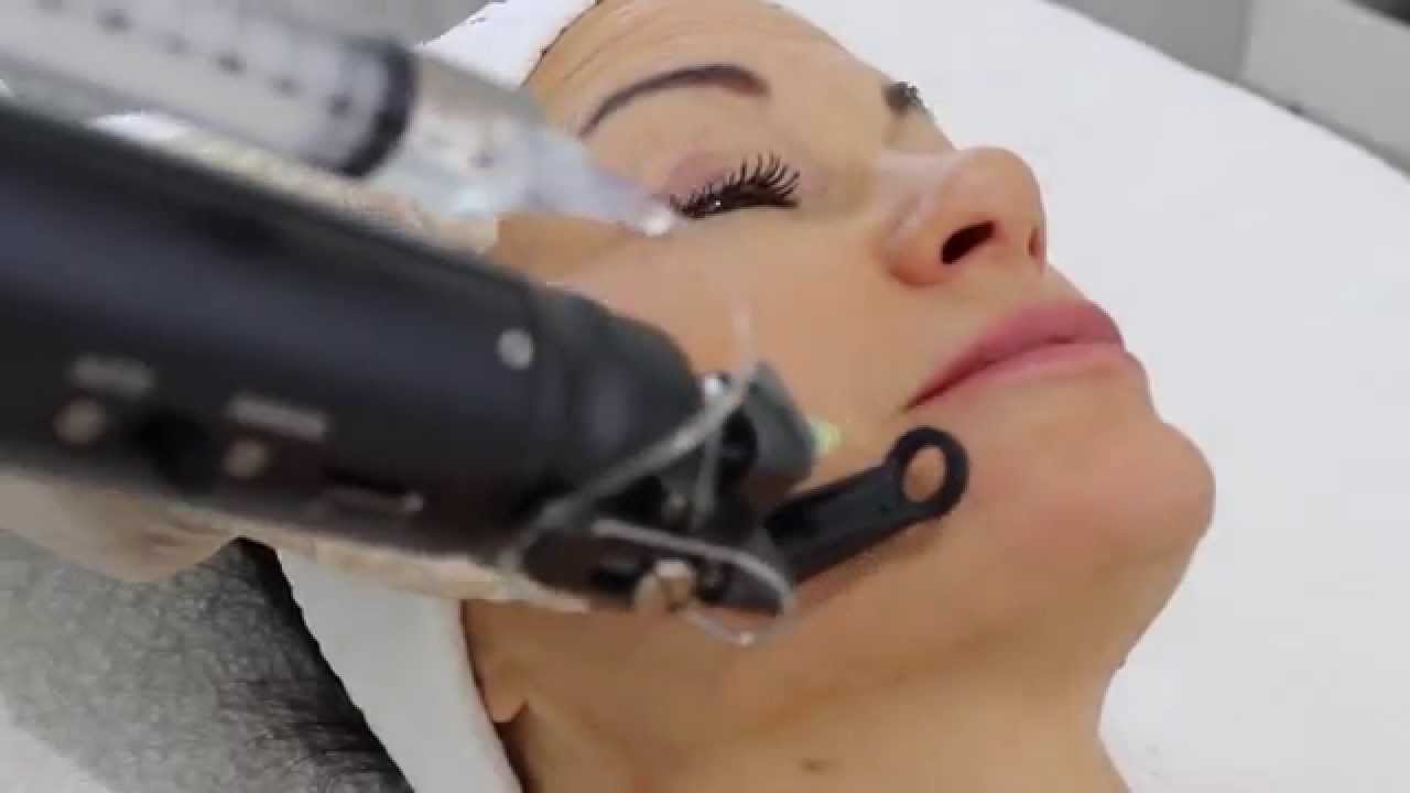 Faltenbehandlung. Hautverj&uuml;ngung mit Hyalurons&auml;ure. www.meso-aesthetik-berlin.de