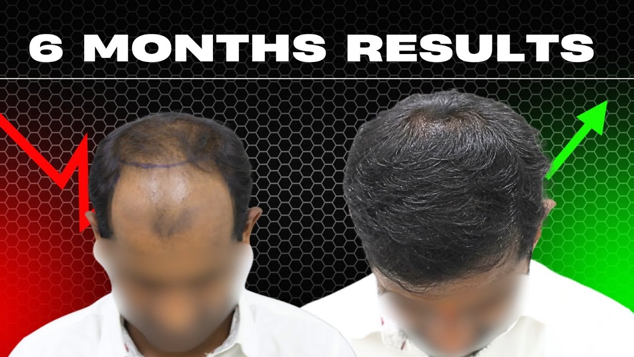 WARANGAL PT AFTER 6 MONTHS RESULTS 