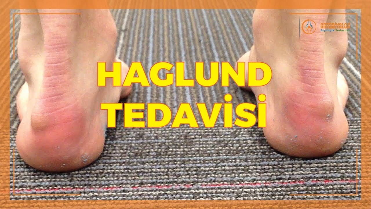 HAGLUND HASTALIĞI VE TEDAVİ YÖNTEMLERİ