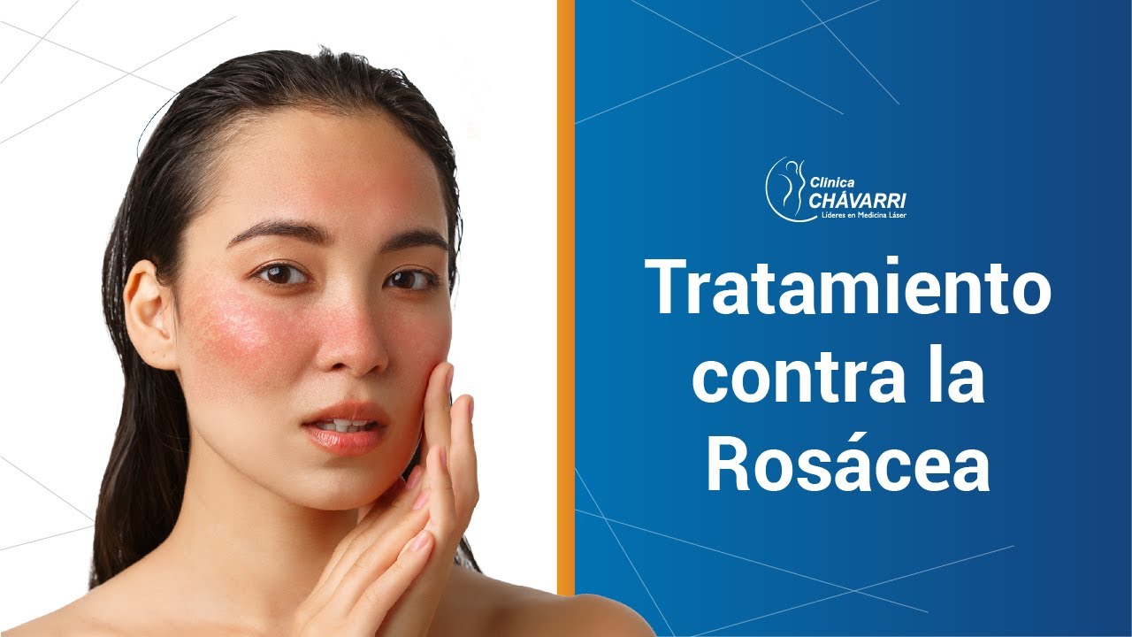 Tratamiento de Luz Pulsada Intensa (IPL) contra la ros&aacute;cea - Cl&iacute;nica Ch&aacute;varri