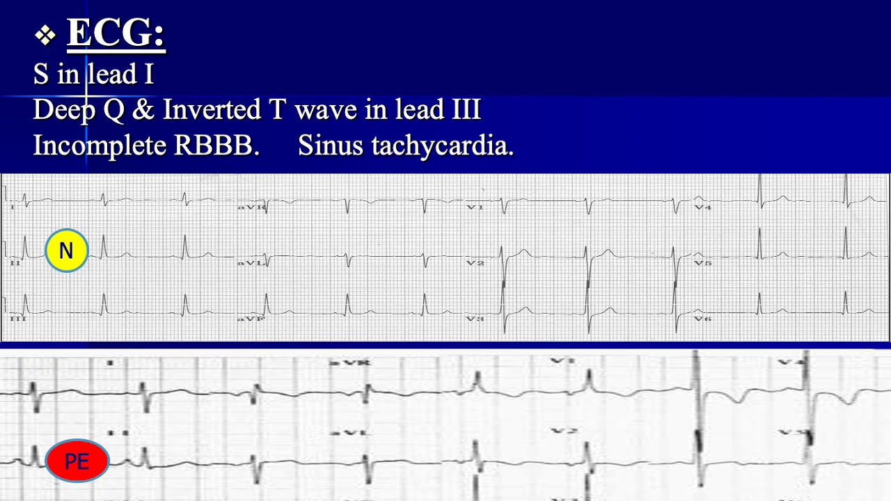 cor pulmonale | cardiology | 5th grade | Prof Mahmoud Abdelsabour