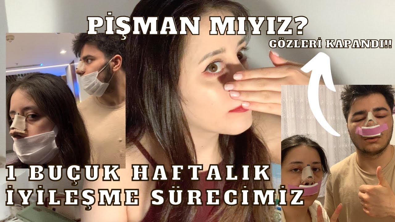 Erkek Kardeşimle Burun Estetiği Sürecimiz | Pişman mıyız? Sonuç