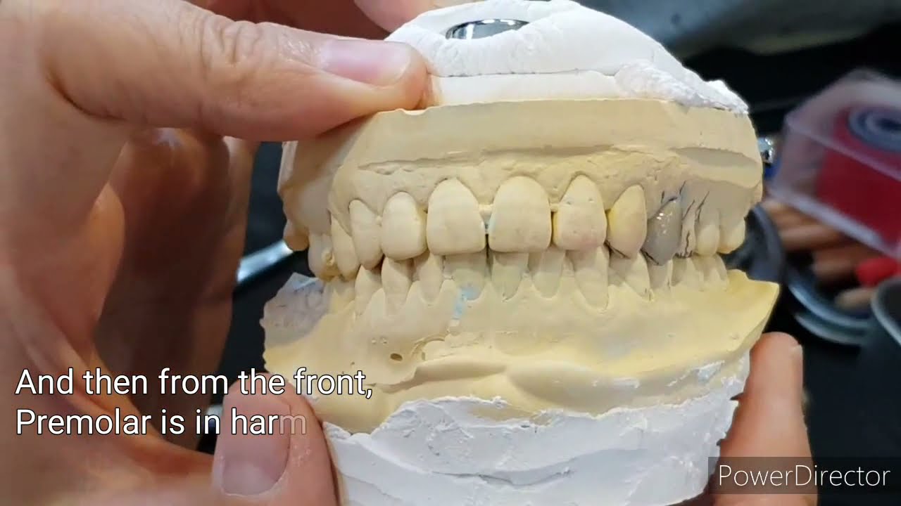 #소구치 #Premolar #상악 #Upper #컨터링 #Contouring Part 1.