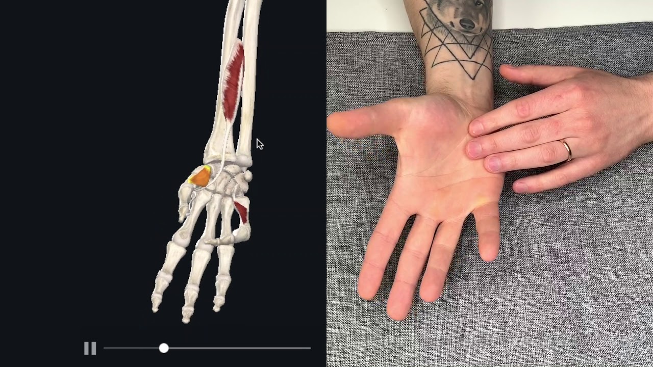 Ako si pomôcť pri bolesti palca na ruke. Rizartróza .Rýchla fyzioterapia
