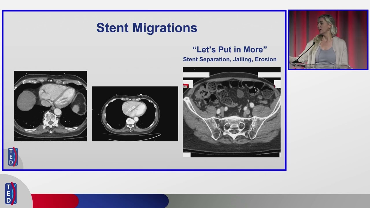 Assessing the Adequacy of Current Venous Stents | Dr. Erin Murphy at TED 2025