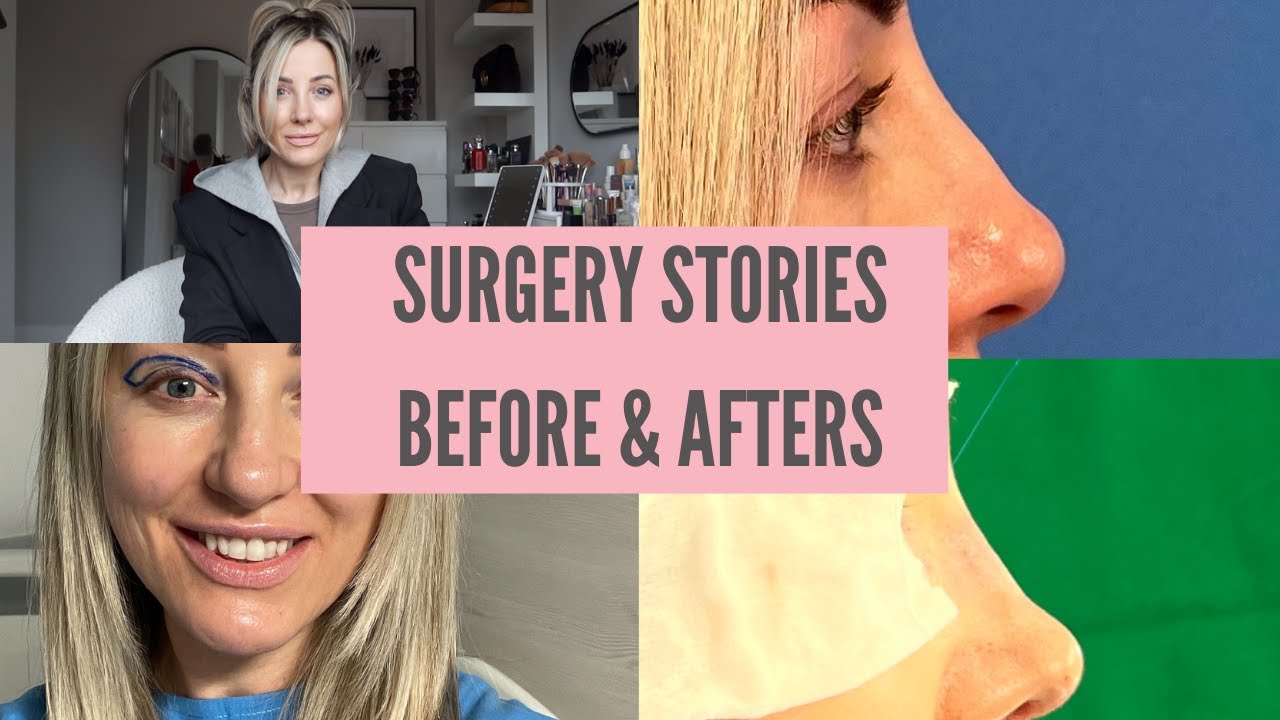 Surgery Stories + Before & Afters! Nords clinic Lithuania