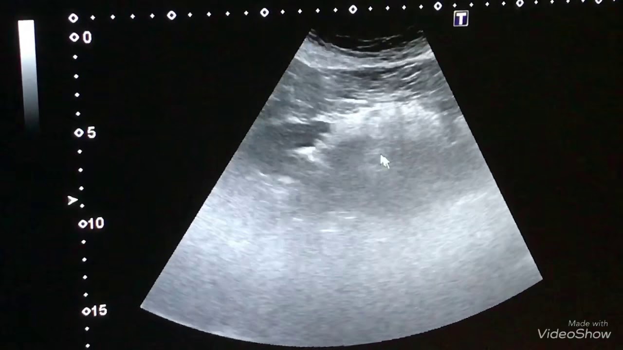 Obez bir hastada karın ultrasonu, karaciğer yağlanması. Ultraschall bei adipösen Patienten.Fettleber