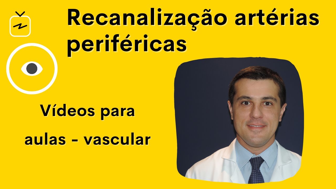Técnicas de Recanalização em Artérias Infrainguinais: fios guia, cateteres