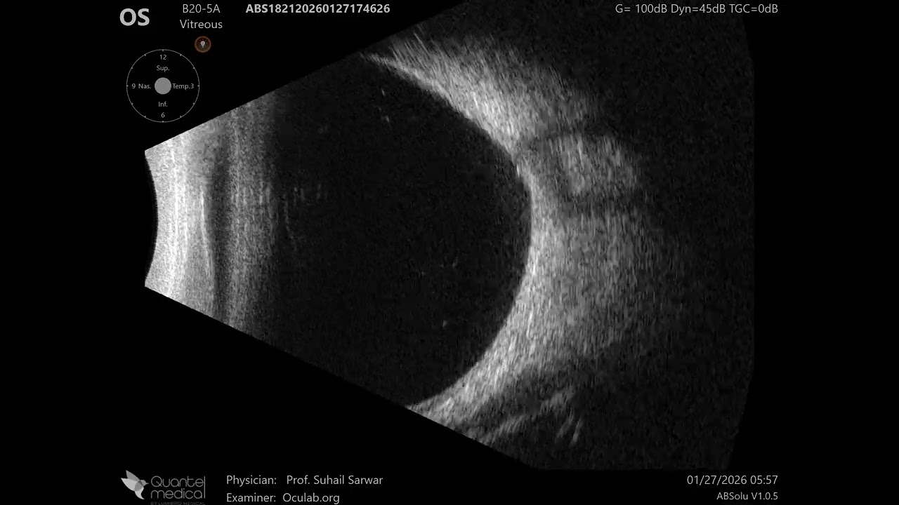 20 MHz Annular Ophthalmic Ultrasound ABSolu, Slight posterior staphyloma , 36948
