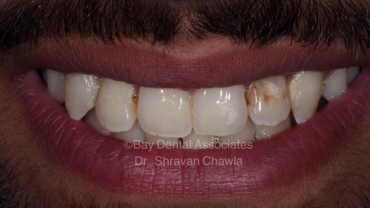 Cosmetic bonding cosmetic dentistry