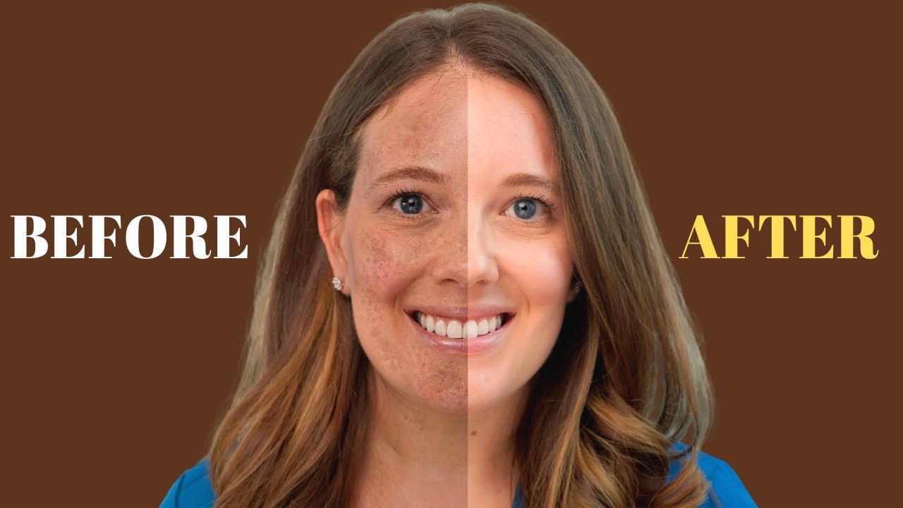 How to Treat Melasma | Dermatology Advice