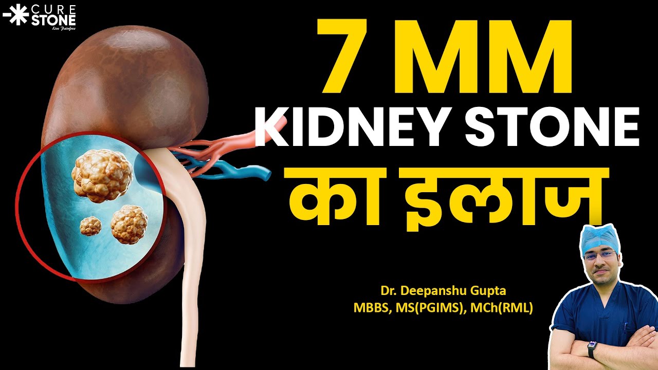 7mm Kidney Stone का इलाज कैसे होता है? | Treatment for 7 mm Kidney stones #kidneystone