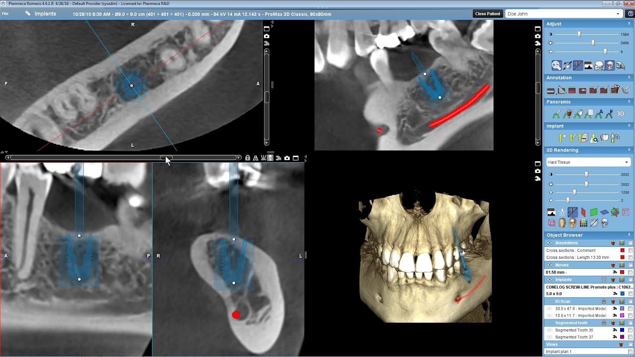 Implant planning