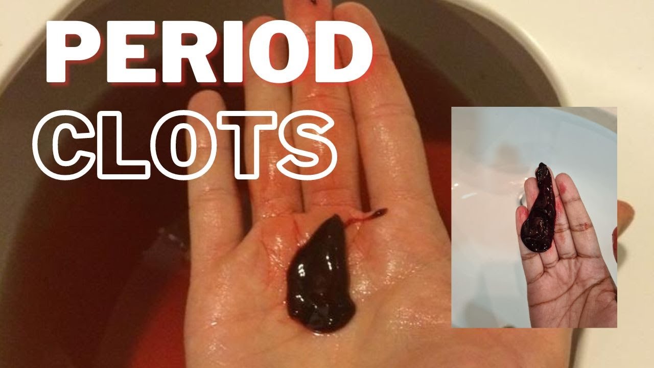 Menstruation Clots | Period Clots - How They Form, Causes and Treatmets