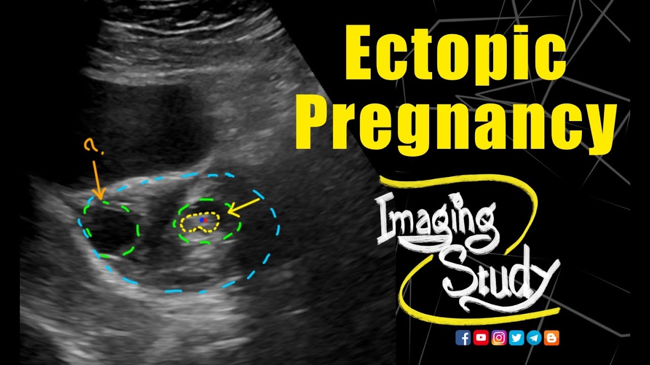 Live Ectopic Pregnancy || Ultrasound || Case 140