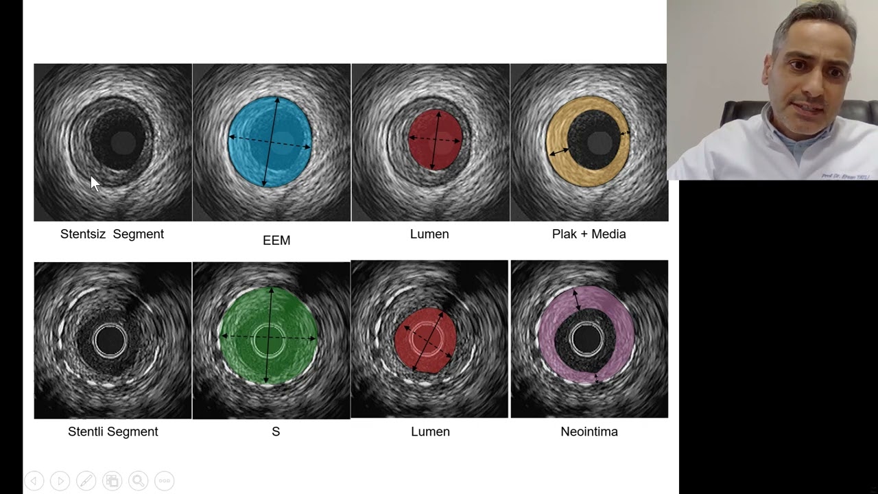IVUS Eşliğinde LMCA lezyonuna Aterektomi Sonrası Başarılı Nanocrush Stentleme