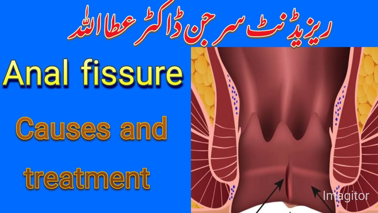 Anal fissure causes and treatment مقعد درارکی وجوہات اور علاج