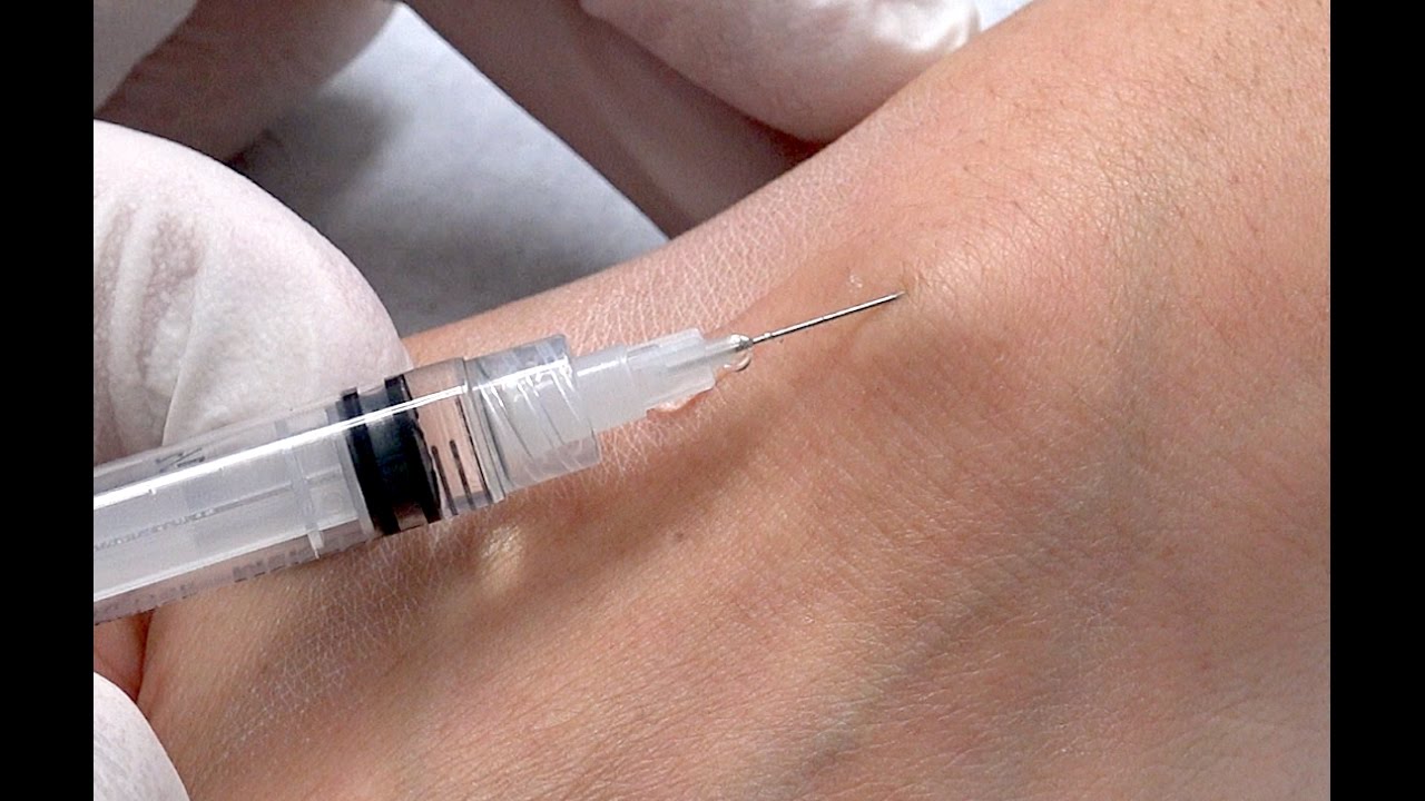 Petra Ganglion Wrist Cyst Aspiration!