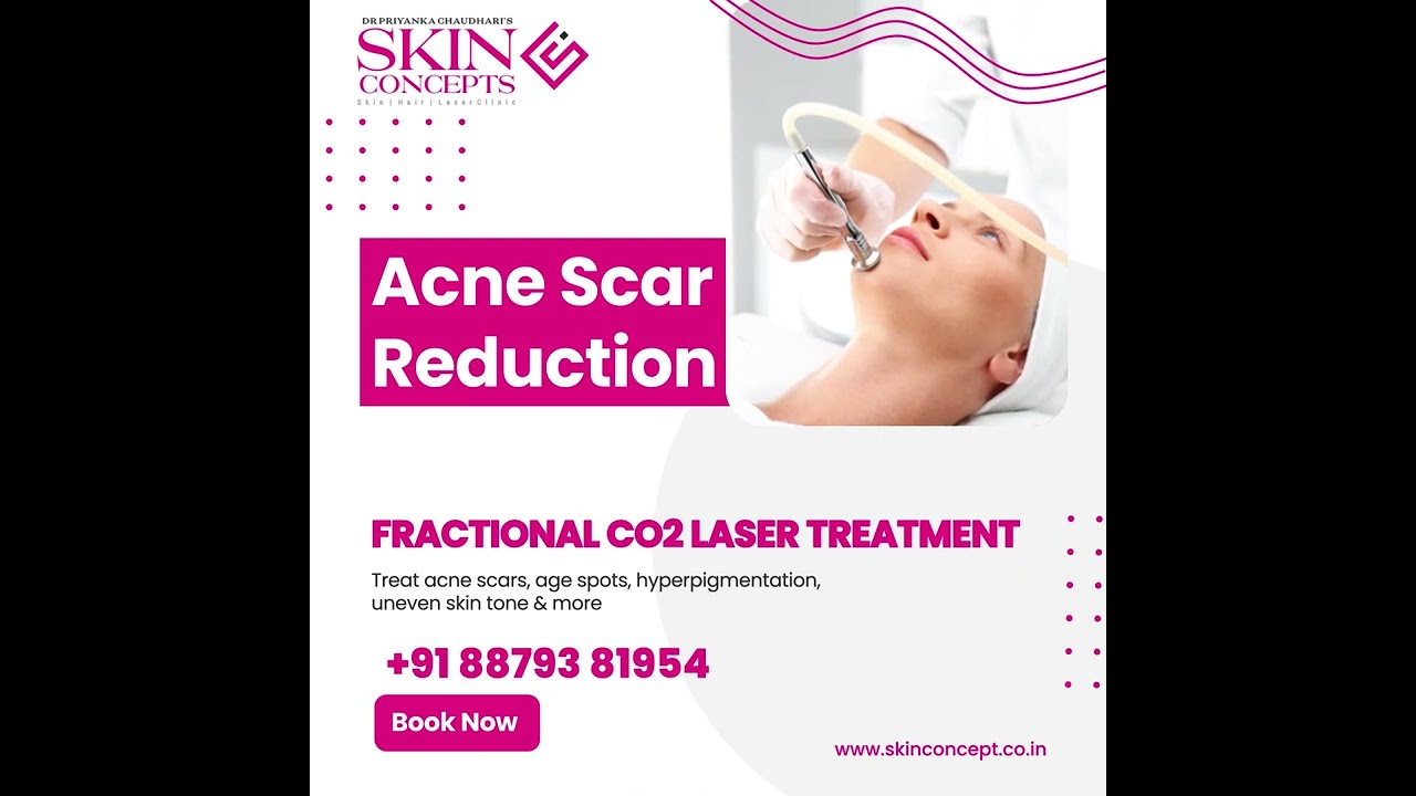 Acne Scar Reduction