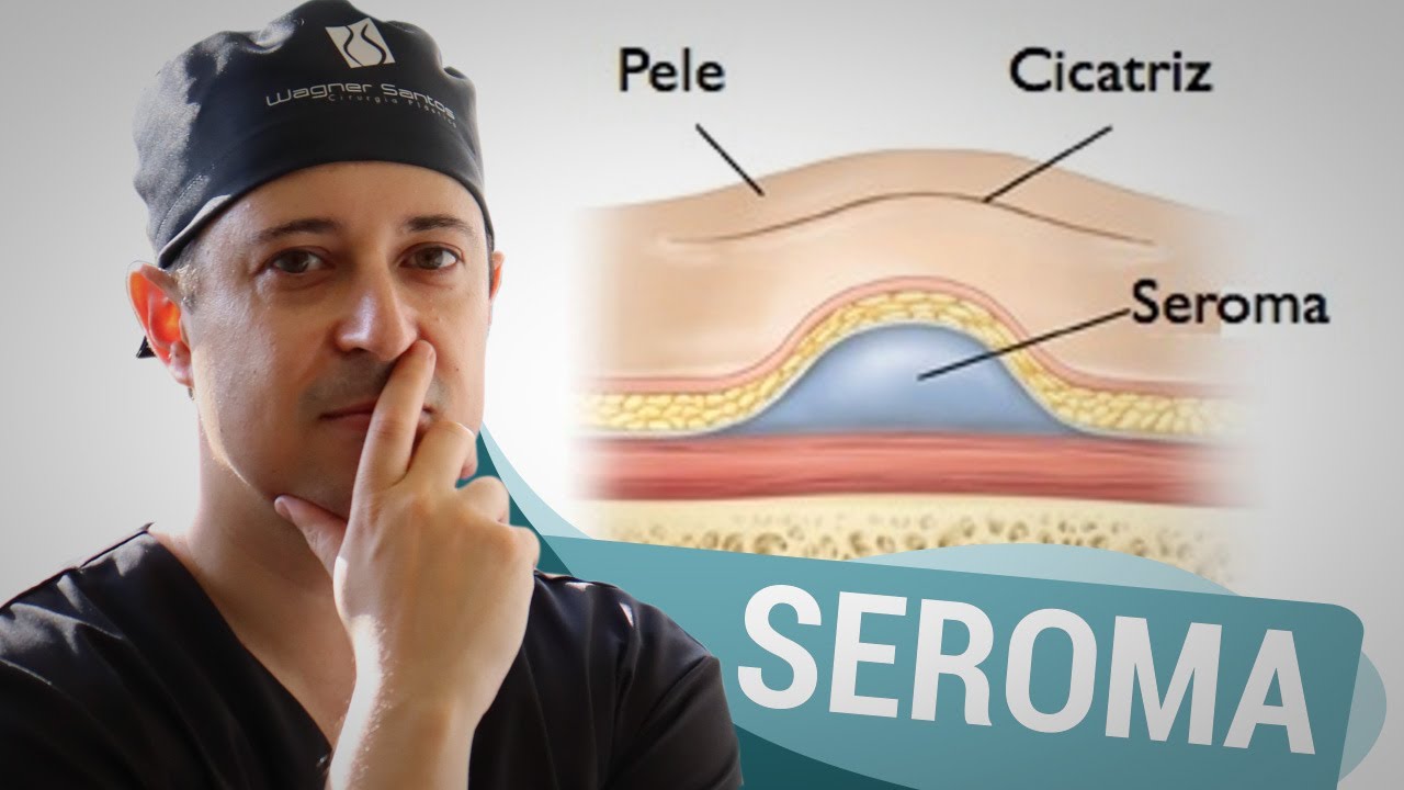 O Seroma no pós operatório