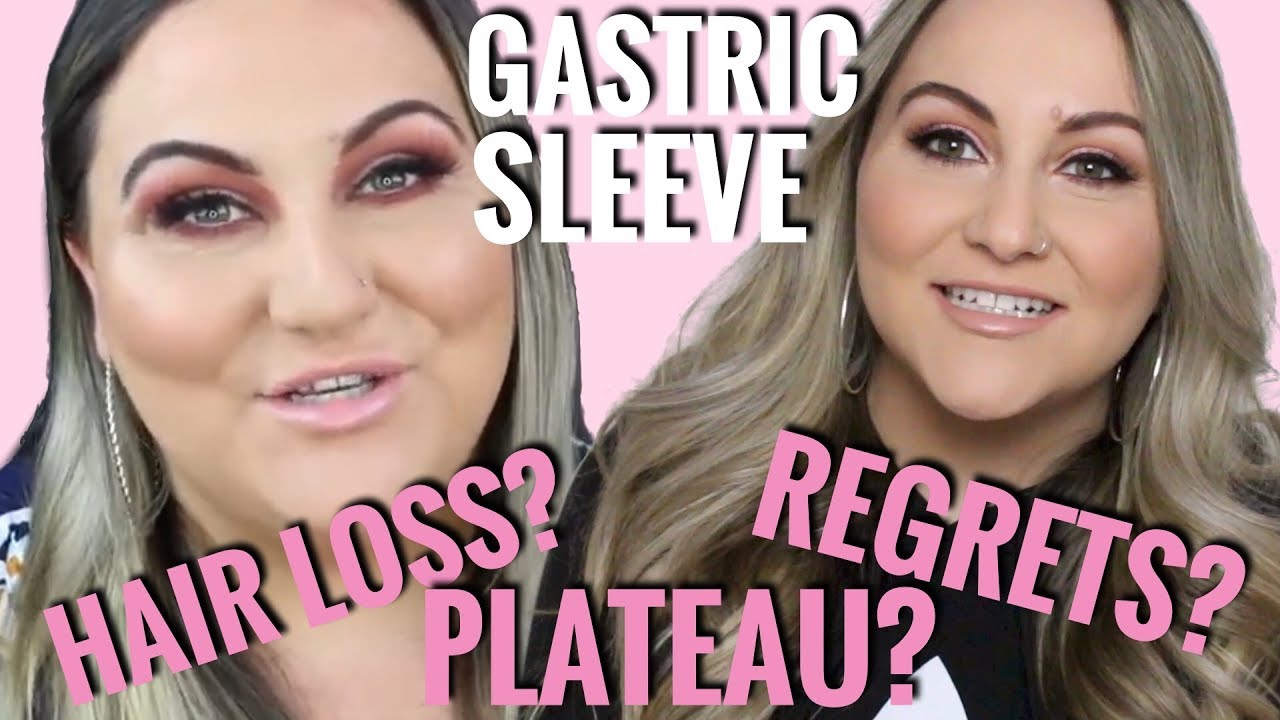 GASTRIC SLEEVE | 4 Months Post Op | Hair Loss, Saggy skin, Regrets?